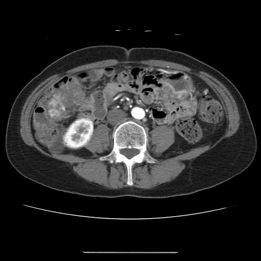 Cavernous hepatic hemangioma (Radiopaedia 75441-86667 A 65).jpg