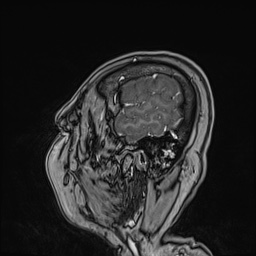 Cavernous sinus meningioma (Radiopaedia 63682-72367 Sagittal T1 C+ 35).jpg