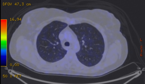 File:Cavitating lung mass - squamous cell carcinoma (Radiopaedia 48047-52853 A 34).png