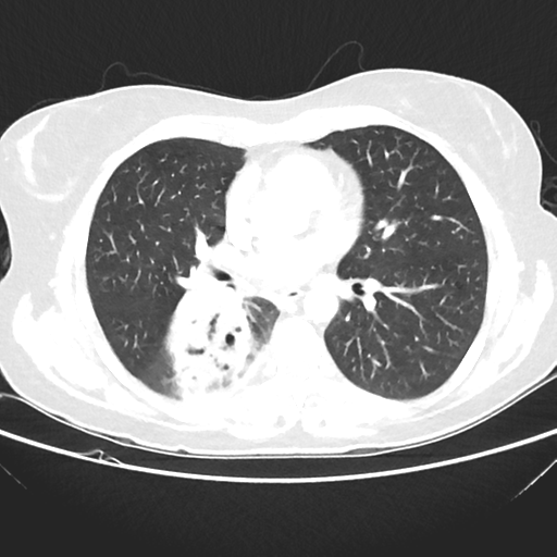 File:Cavitating lung mass - squamous cell carcinoma (Radiopaedia 48047-52854 Axial lung window 26).png