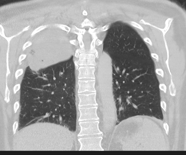 Cavitating pneumonia (Radiopaedia 45998-50329 Coronal lung window 36).png