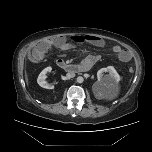 Cecal adenocarcinoma (Radiopaedia 64871-73817 A 39).jpg