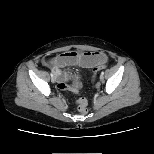 Cecal adenocarcinoma (Radiopaedia 75909-87331 A 74).jpg
