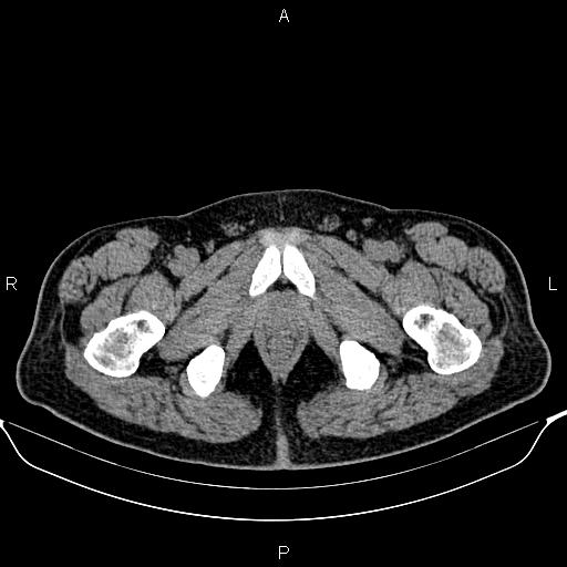 Cecal adenocarcinoma (Radiopaedia 85324-100916 Axial non-contrast 104).jpg