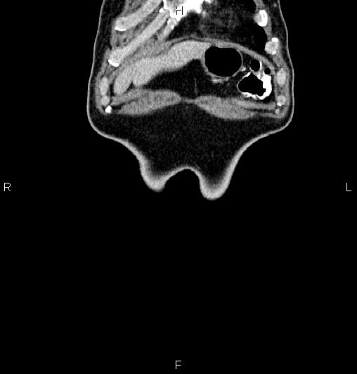 Cecal adenocarcinoma (Radiopaedia 85324-100916 D 1).jpg