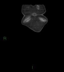 Cecal volvulus (Radiopaedia 86741-102900 B 77).jpg