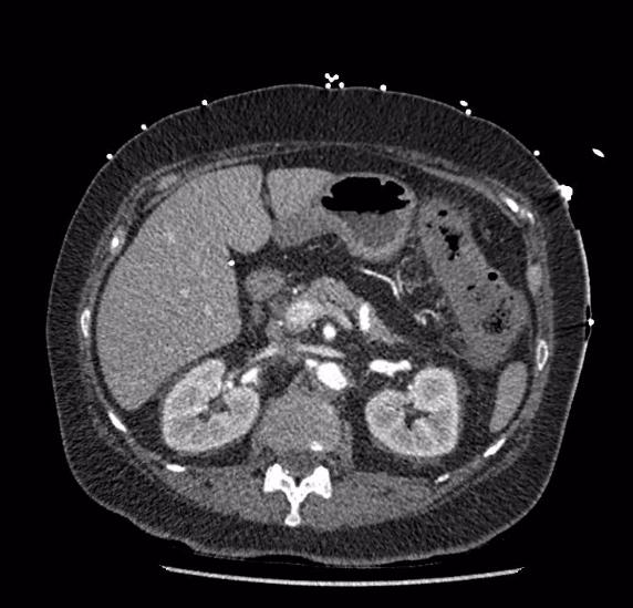 Celiac artery severe stenosis and dissection (Radiopaedia 44128-47842 B 30).jpg