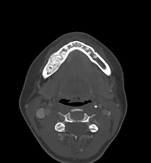 Cemento-ossifying fibroma (Radiopaedia 46243-50643 Axial bone window 45).png