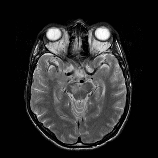 File:Central-variant posterior reversible encephalopathy syndrome (PRES) (Radiopaedia 43880-47358 Axial T2 9).jpg