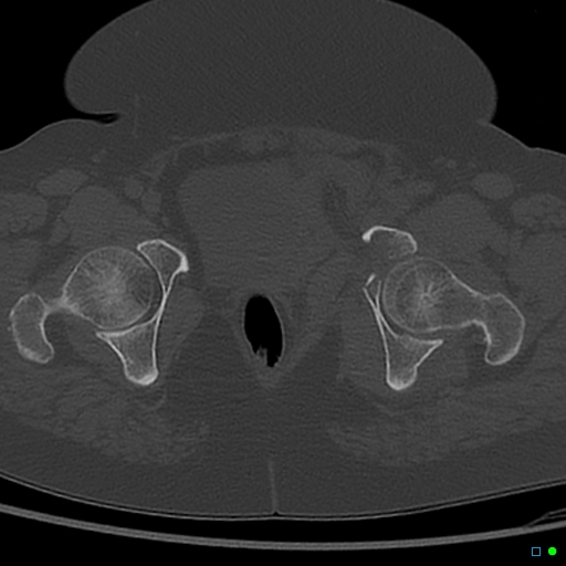 File:Central fracture-dislocation of the acetabulum (Radiopaedia 36578-38150 Axial bone window 66).jpg