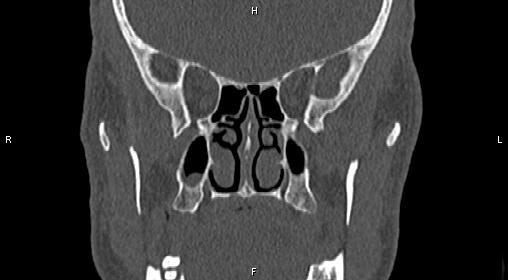 File:Central giant cell granuloma (Radiopaedia 83346-97761 Coronal bone window 18).jpg