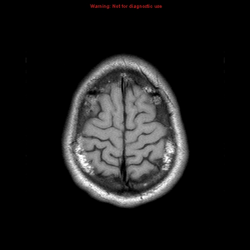 File:Central nervous system vasculitis (Radiopaedia 8410-9235 Axial T1 22).jpg