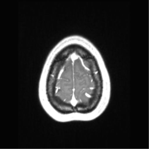 File:Central neurocytoma (Radiopaedia 37664-39557 Axial T1 C+ 72).png