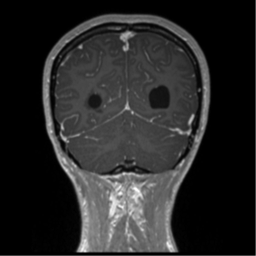 Central neurocytoma (Radiopaedia 37664-39557 Coronal T1 C+ 20).png