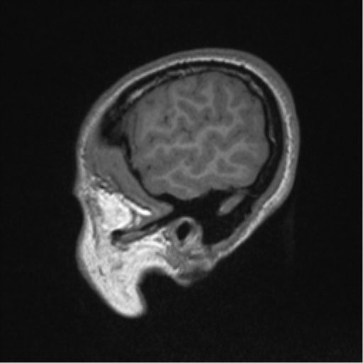 Central neurocytoma (Radiopaedia 37664-39557 Sagittal T1 15).png