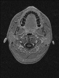 Central neurocytoma (Radiopaedia 56690-63469 Axial T1 C+ 4).jpg