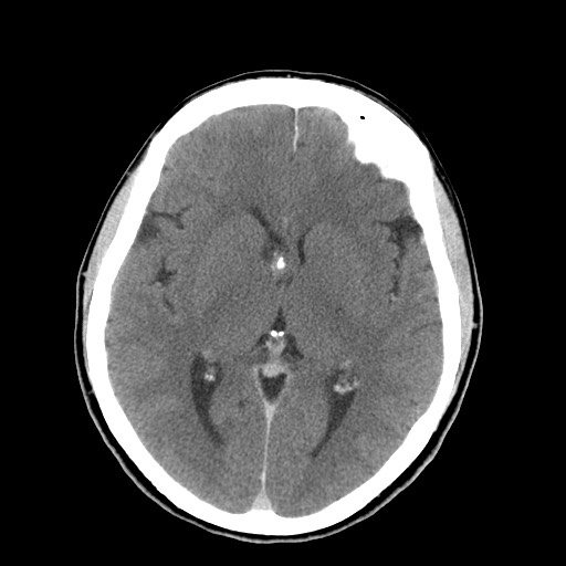 File:Central neurocytoma (Radiopaedia 68725-78432 Axial C+ 38).jpg