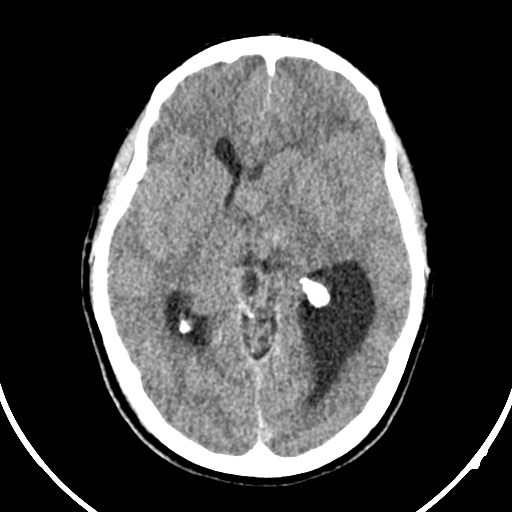 Central neurocytoma (Radiopaedia 84497-99871 Axial non-contrast 22).jpg