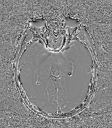 Central neurocytoma (Radiopaedia 84497-99872 Axial 30).jpg