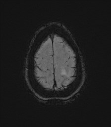 File:Central neurocytoma (Radiopaedia 84497-99872 Axial SWI 63).jpg