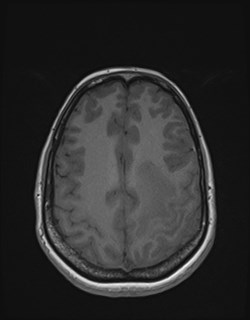 Central neurocytoma (Radiopaedia 84497-99872 Axial T1 145).jpg