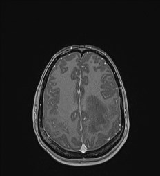 Central neurocytoma (Radiopaedia 84497-99872 Axial T1 C+ 117).jpg