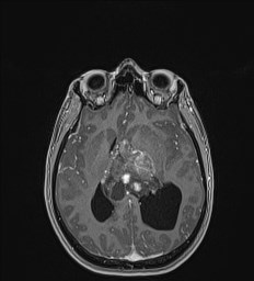 Central neurocytoma (Radiopaedia 84497-99872 Axial T1 C+ 83).jpg