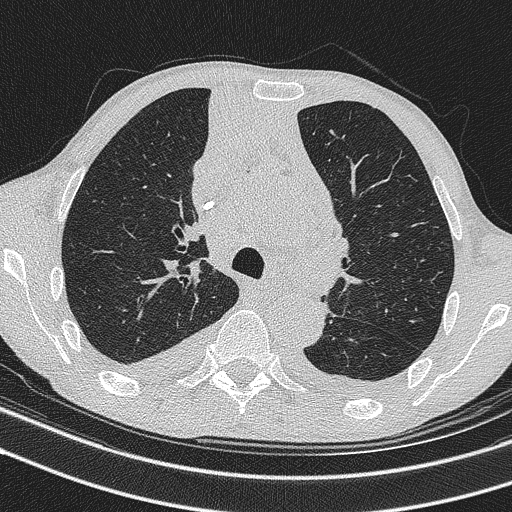 Central venous catheter tip extravasation (Radiopaedia 82828-97113 Axial lung window 33).jpg