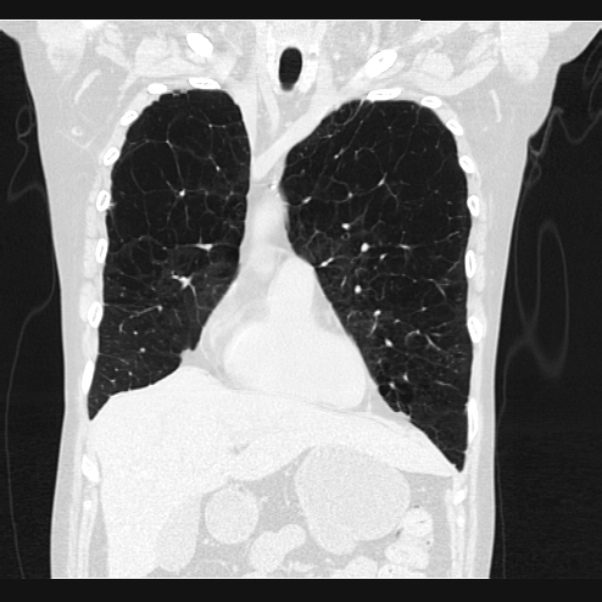 Centrilobular pulmonary emphysema (Radiopaedia 24495-24789 Coronal lung window 21).jpg