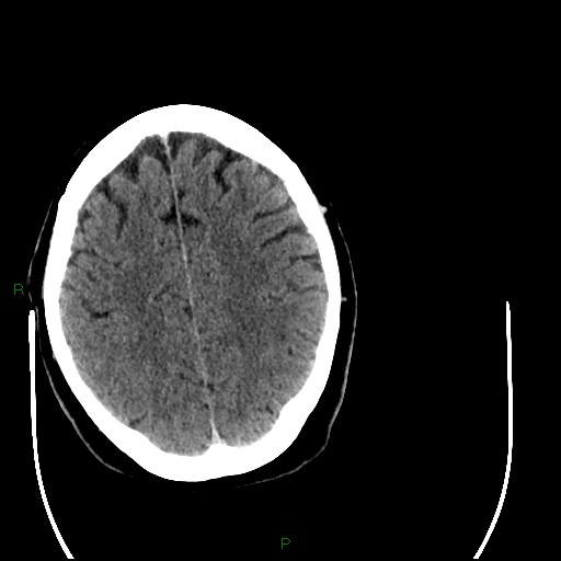 Cerebellar abscess (Radiopaedia 78135-90671 Axial C+ delayed 79).jpg