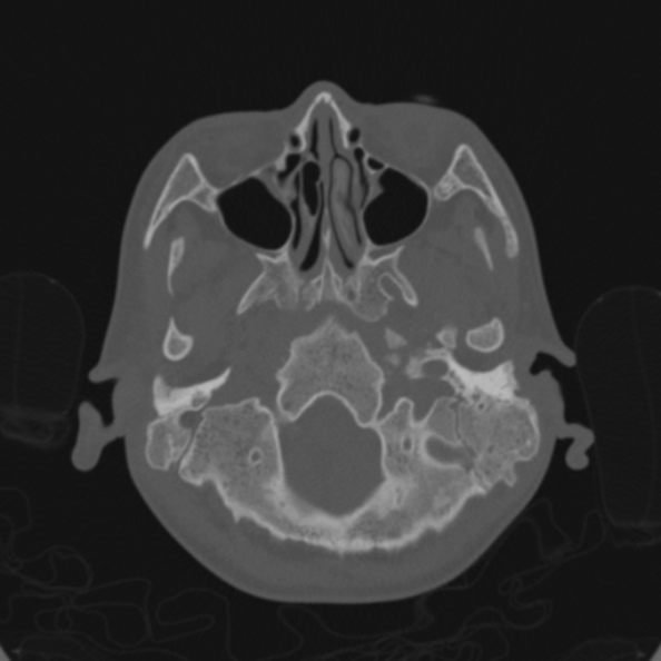 File:Cerebellar abscess secondary to mastoiditis (Radiopaedia 26284-26413 Axial bone window 27).jpg