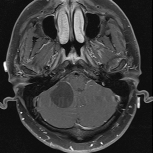 File:Cerebellar hemangioblastomas and pituitary adenoma (Radiopaedia 85490-101176 Axial T1 C+ fat sat 8).png