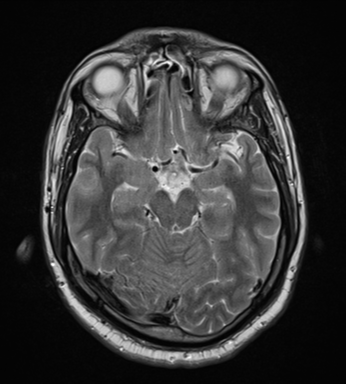 File:Cerebellar hemangioblastomas and pituitary adenoma (Radiopaedia 85490-101176 Axial T2 14).png