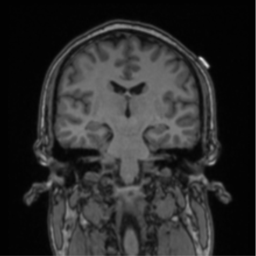 Cerebellar hemangioblastomas and pituitary adenoma (Radiopaedia 85490-101176 Coronal T1 45).png