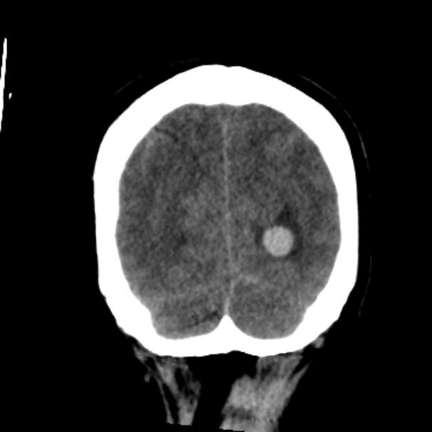 Cerebellar hemorrhage causing obstructive hydrocephalus (Radiopaedia 33989-35207 Coronal non-contrast 46).jpg