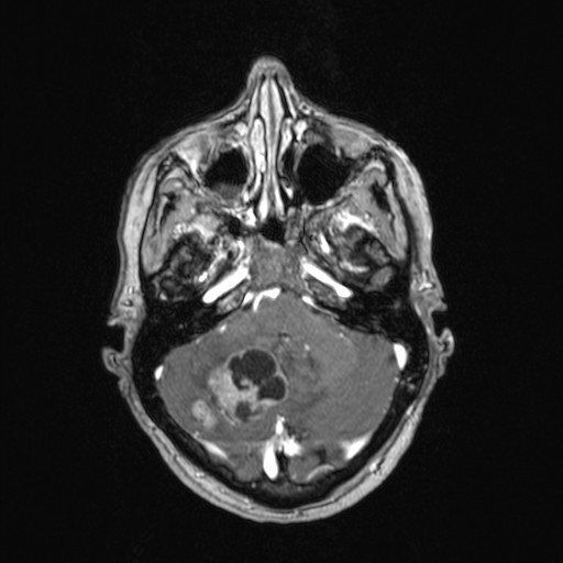 File:Cerebellar metastases (Radiopaedia 24038-24249 Axial T1 C+ 40).jpg