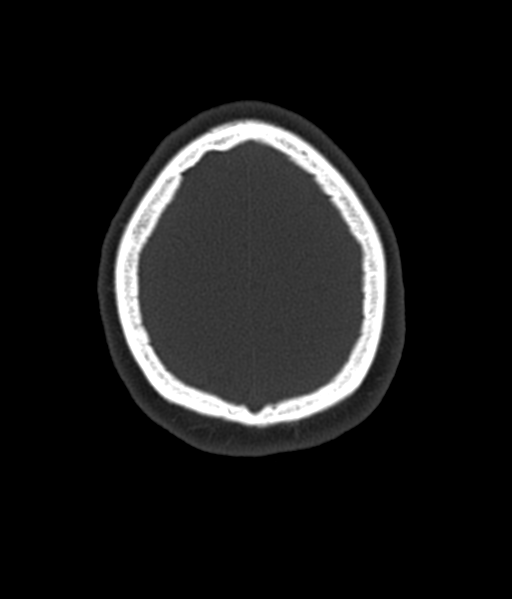 Cerebellar metastases - colorectal adenocarcinoma (Radiopaedia 40947-43652 AX Bone C- 2.0 MPR 57).png