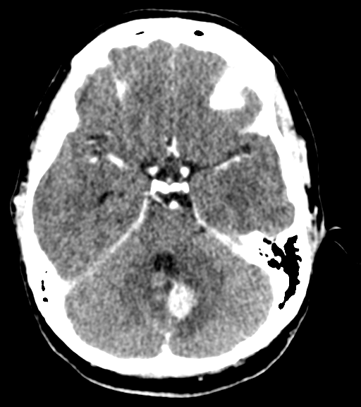 Cerebellar metastases - colorectal adenocarcinoma (Radiopaedia 40947-43652 Axial C+ 17).png