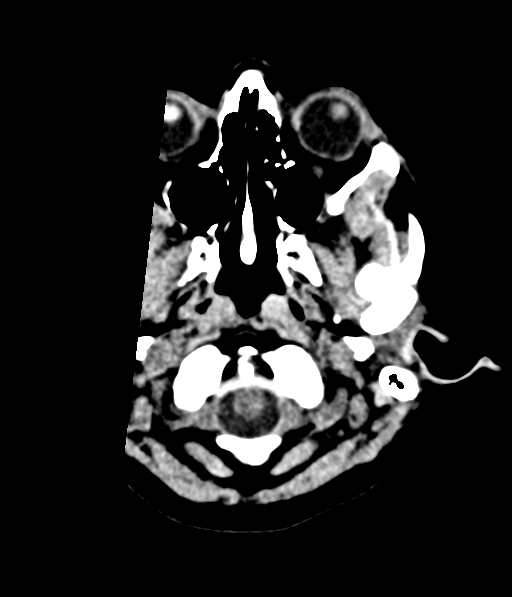 Cerebellar metastases - colorectal adenocarcinoma (Radiopaedia 40947-43652 Axial non-contrast 3).png