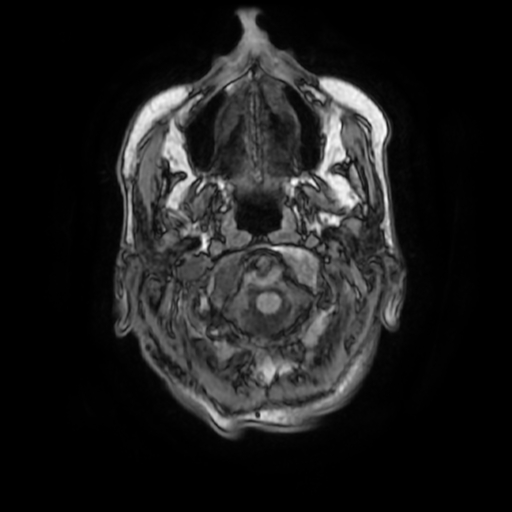 File:Cerebellar metastasis - lung tumor (Radiopaedia 69317-79147 Axial T1 5).jpg