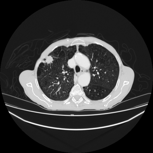 File:Cerebellar metastasis - lung tumor (Radiopaedia 69317-79150 Axial lung window 10).jpg