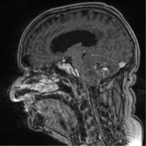 Cerebellar metastasis from lung adenocarcinoma (Radiopaedia 86690-102829 Sagittal T1 C+ 47).png
