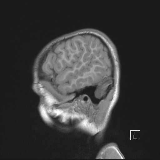Cerebellar stroke (Radiopaedia 32202-33150 Sagittal T1 C+ 6).png