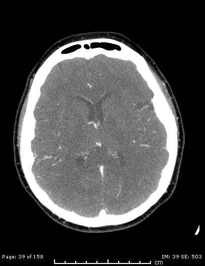 Cerebellar strokes due to intracranial giant cell arteritis (Radiopaedia 68799-78510 CT angiogram 39).jpg