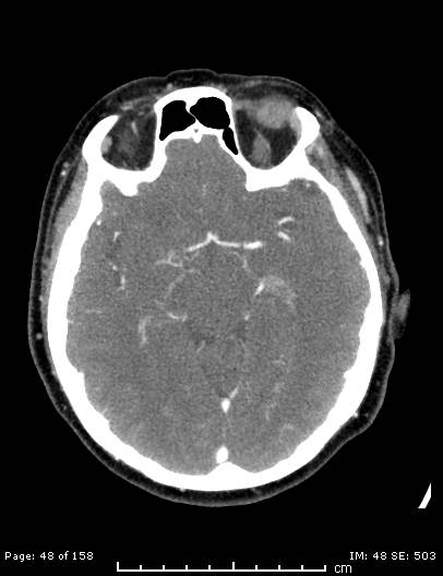 Cerebellar strokes due to intracranial giant cell arteritis (Radiopaedia 68799-78510 CT angiogram 48).jpg
