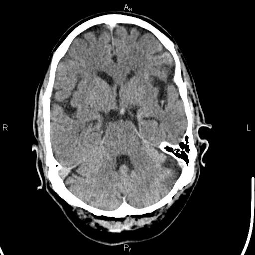 File:Cerebellopontine angle arachnoid cyst (Radiopaedia 85149-100704 Axial With contrast 16).jpg