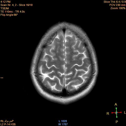 File:Cerebellopontine angle meningioma (Radiopaedia 22488-22525 Axial T2 14).jpg