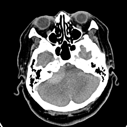 Cerebellopontine angle meningioma (Radiopaedia 35181-36714 A 31).jpg