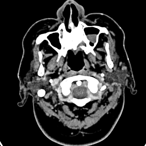 Cerebellopontine angle meningioma (Radiopaedia 35181-36714 A 64).jpg