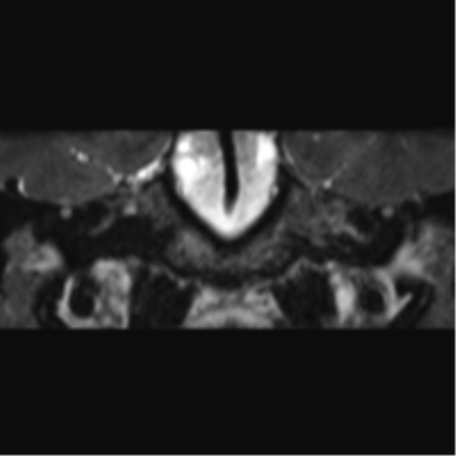 File:Cerebellopontine angle meningioma (Radiopaedia 48434-53348 Coronal T2 60).png